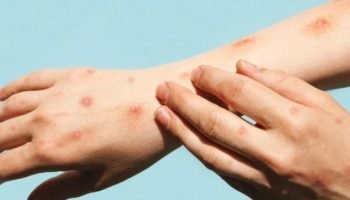 Ilustração de vírus da Mpox com destaque em lesões cutâneas e sintomas associado